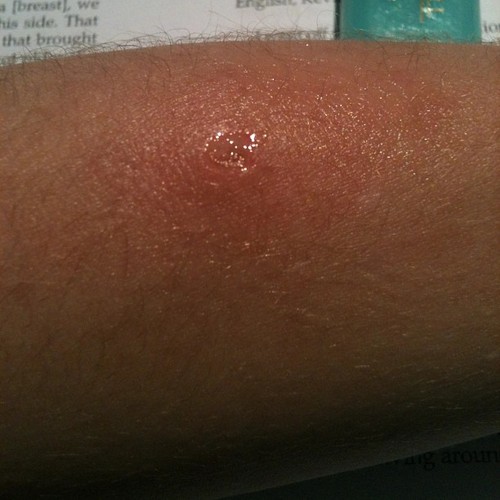 Infected sore on left forearm...